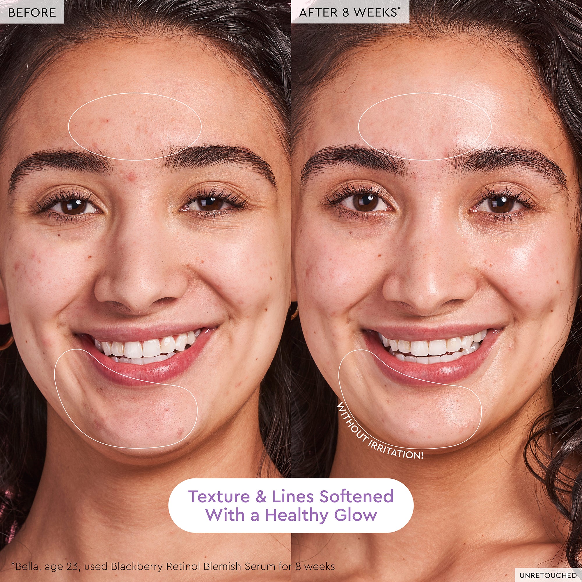 Blackberry Retinol Blemish Serum - Image 6