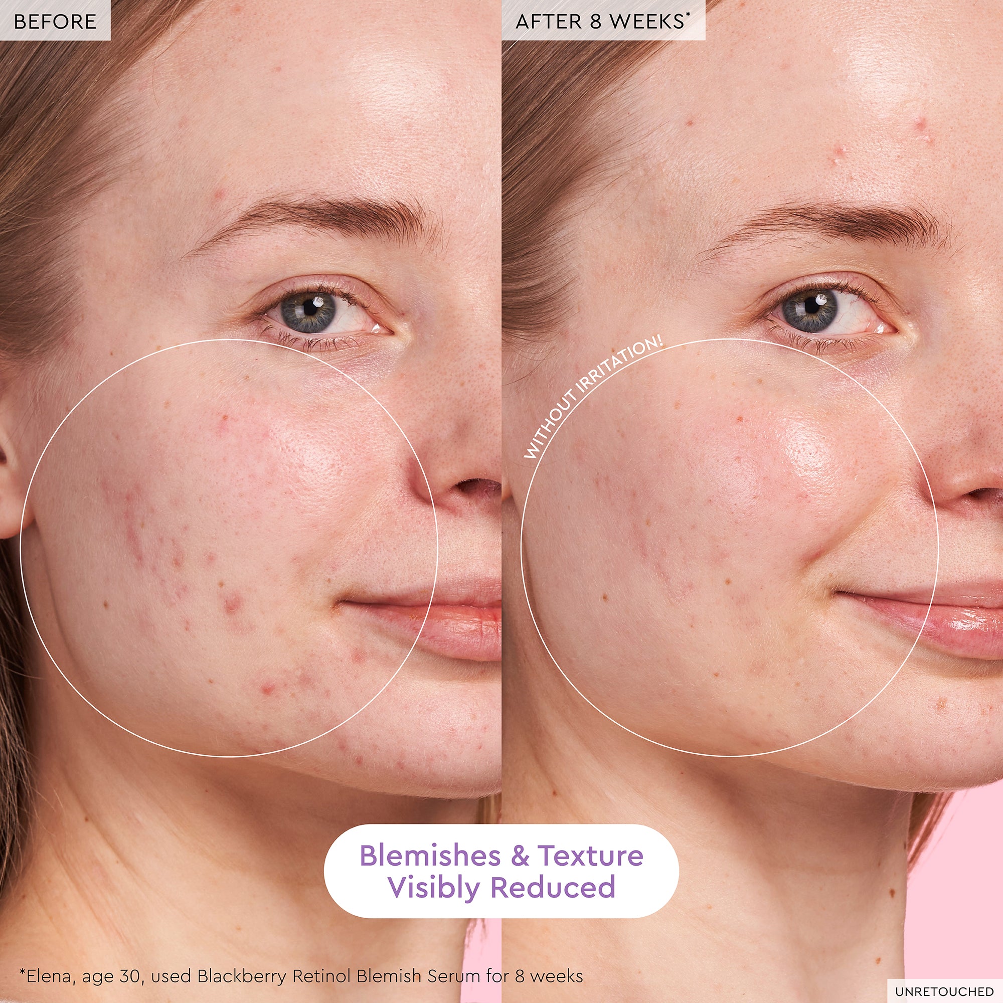 Blackberry Retinol Blemish Serum - Image 3